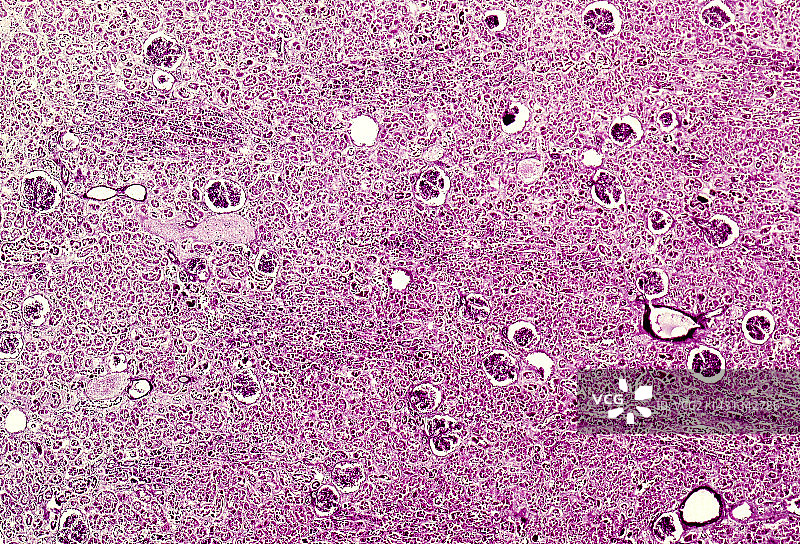 膜性肾小球肾炎，光学显微照片图片素材