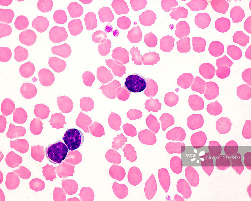 慢性淋巴细胞白血病图片素材