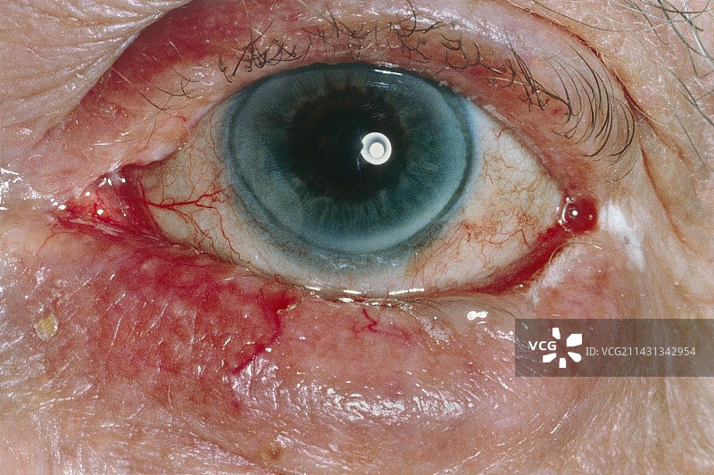 睑内翻图片素材