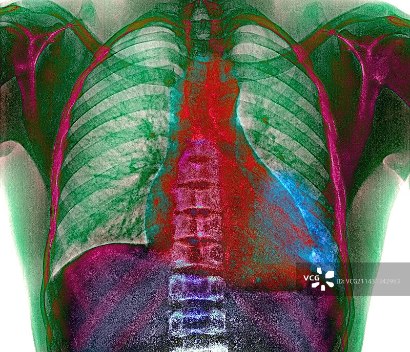 肺部感染图片素材