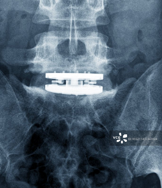 椎间骨植入X光片图片素材