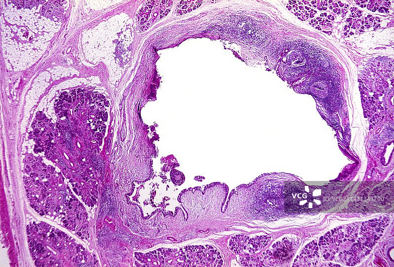 发炎的唾液腺，光学显微照片图片素材