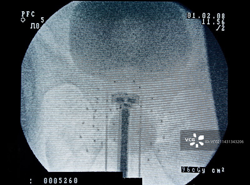 前列腺癌放射治疗扫描图片素材