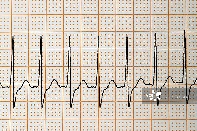 心跳的交界性节律图片素材