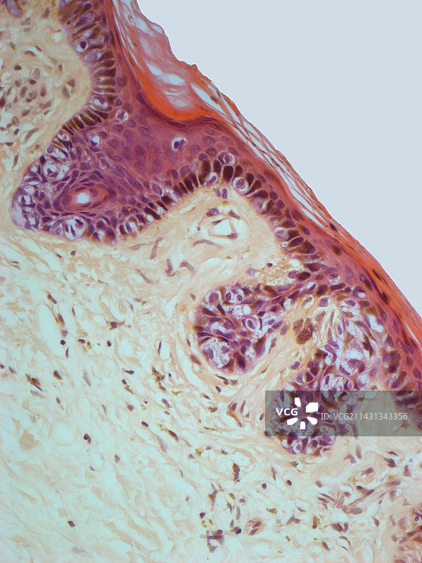 皮肤癌显微照片图片素材