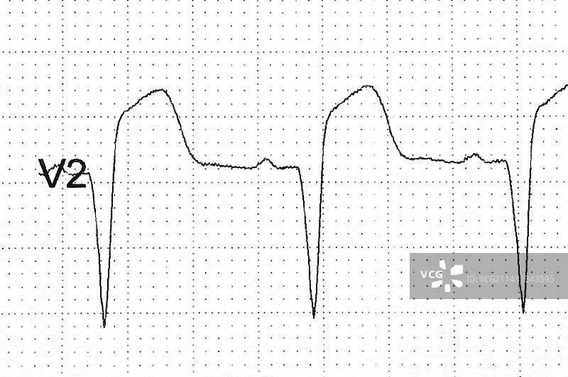 心电图显示心脏病发作，V2电极图片素材