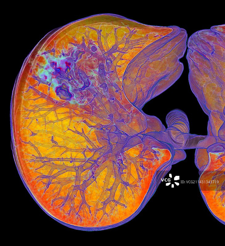 受新冠肺炎非典型肺炎影响的肺部3D CT扫描图片素材