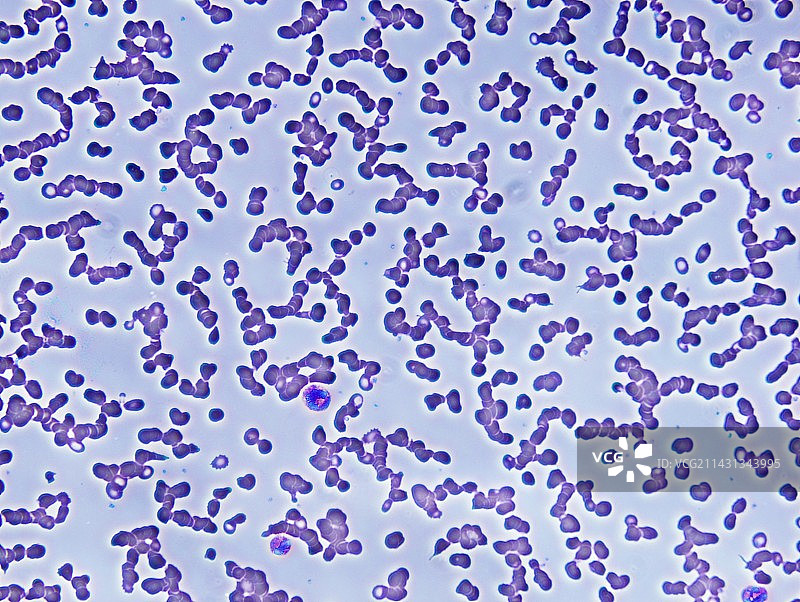 恶性贫血图片素材