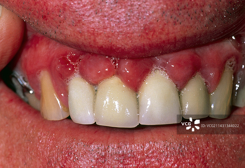 因药物硝苯地平引起的牙龈增生图片素材