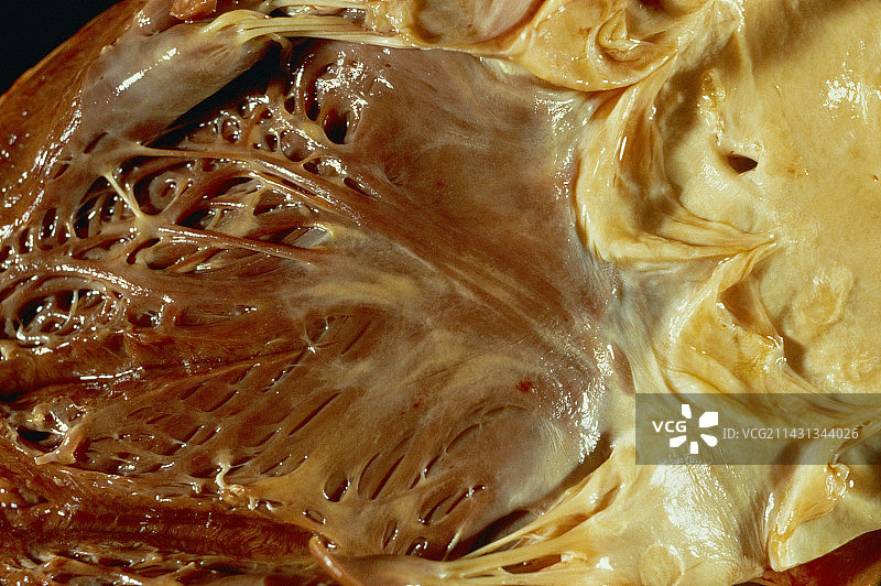 心脏脂肪沉积图片素材