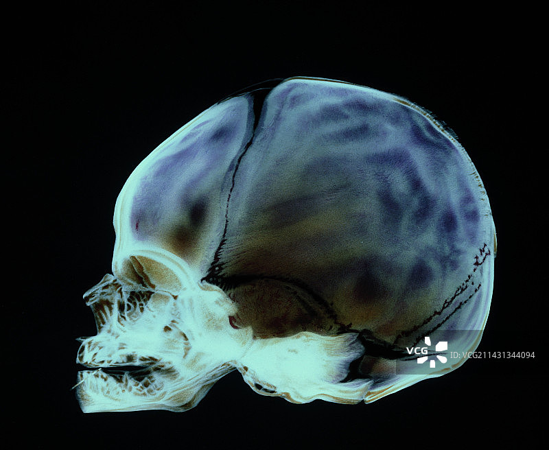 婴儿正常颅骨彩色X光片图片素材