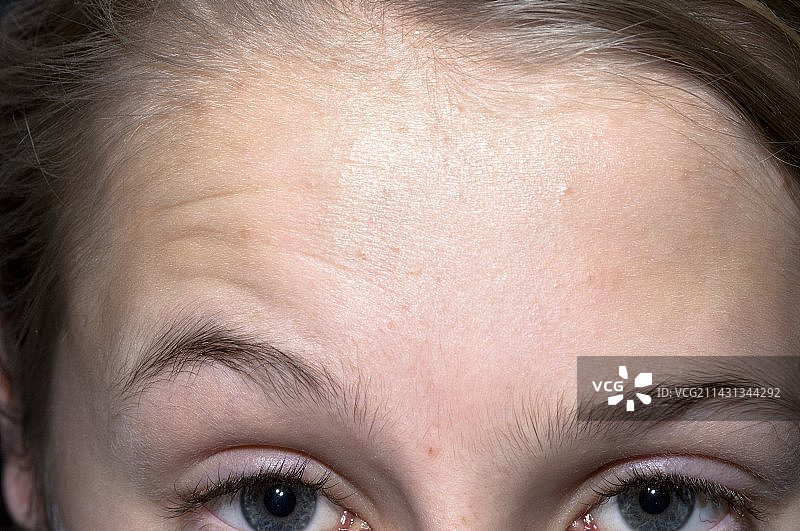 贝尔麻痹症图片素材