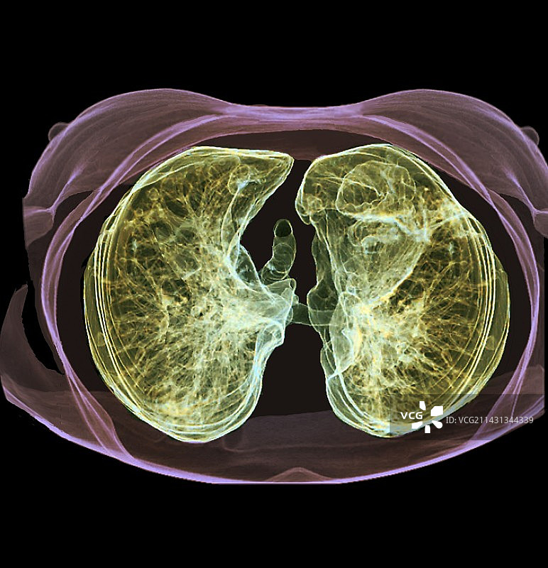 健康肺部3D CT扫描图片素材