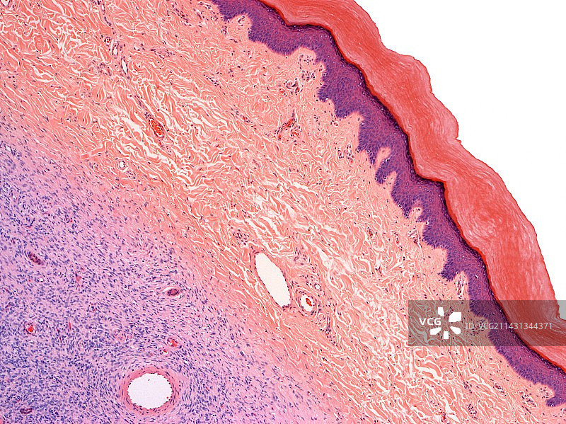 皮肤癌浅显显微照片图片素材