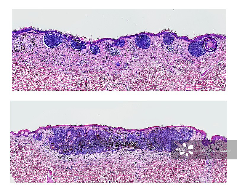 皮肤癌浅显显微照片图片素材