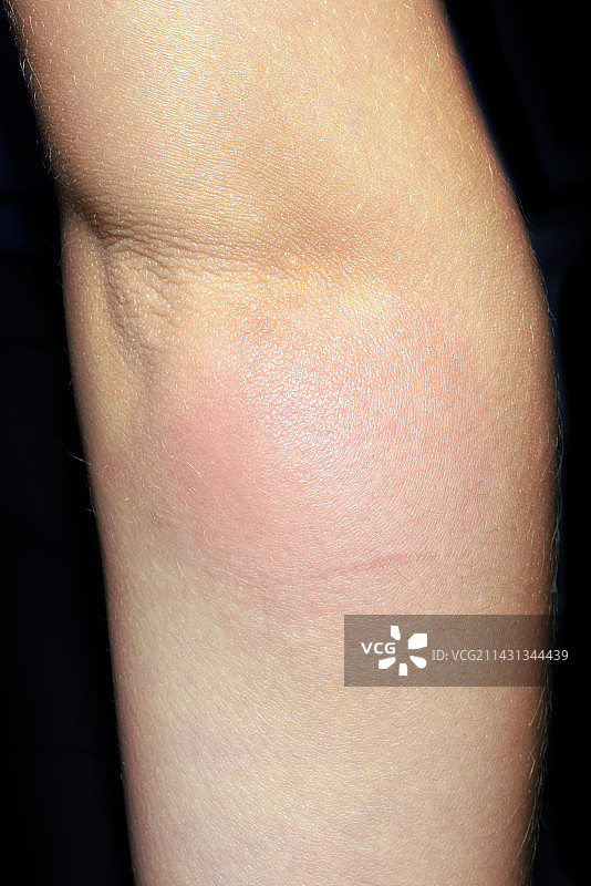 蚊虫叮咬过敏反应图片素材