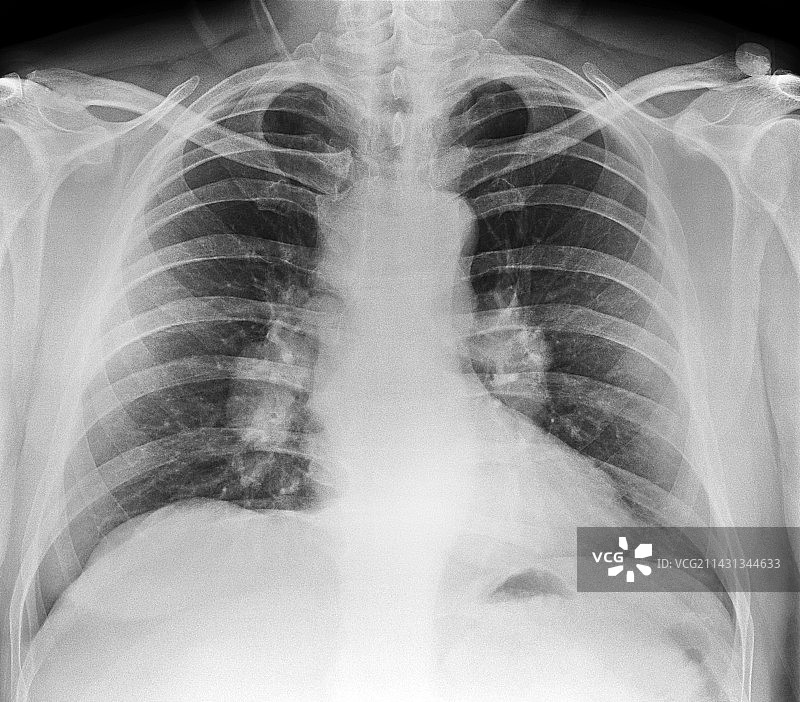 肺部结节病X光片图片素材