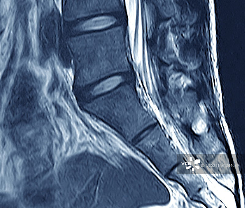健康的脊椎核磁共振扫描图片素材