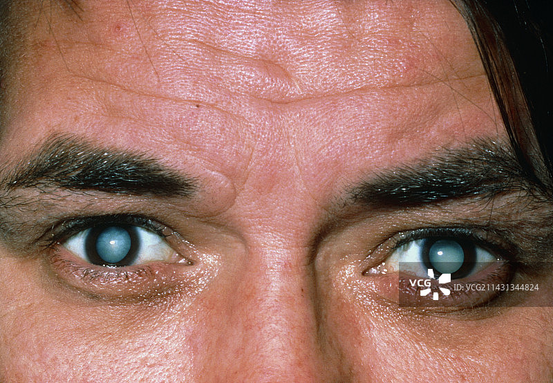 患有老年性白内障的男病人眼睛图片素材