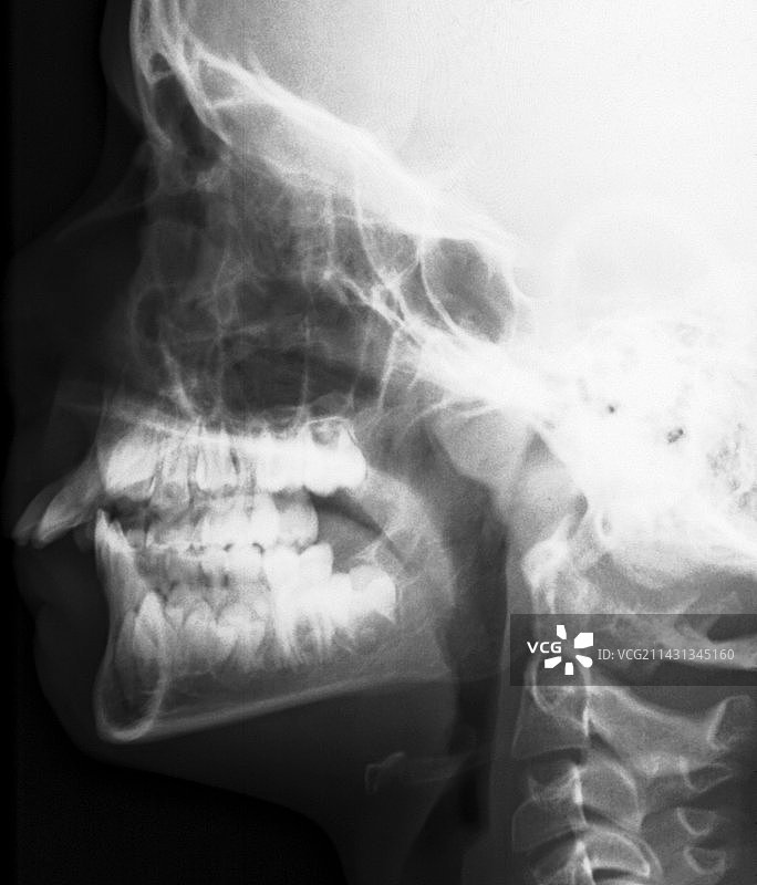 儿童腺样体肥大X光片图片素材