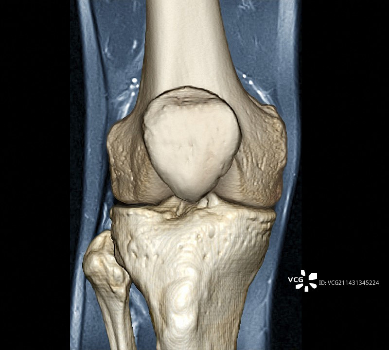 健康的膝盖CT扫描图片素材