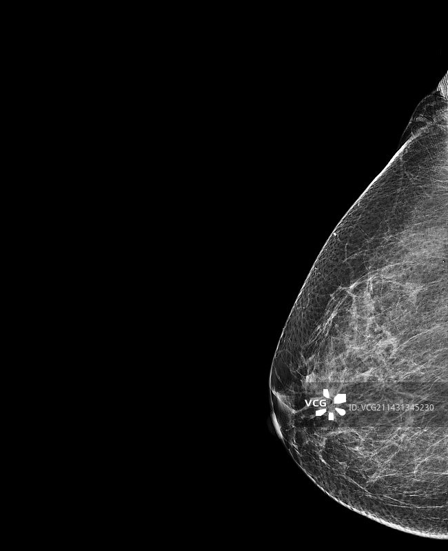 乳房X光检查图片素材