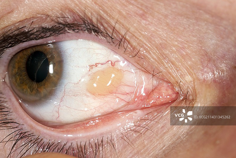 睑裂斑图片素材