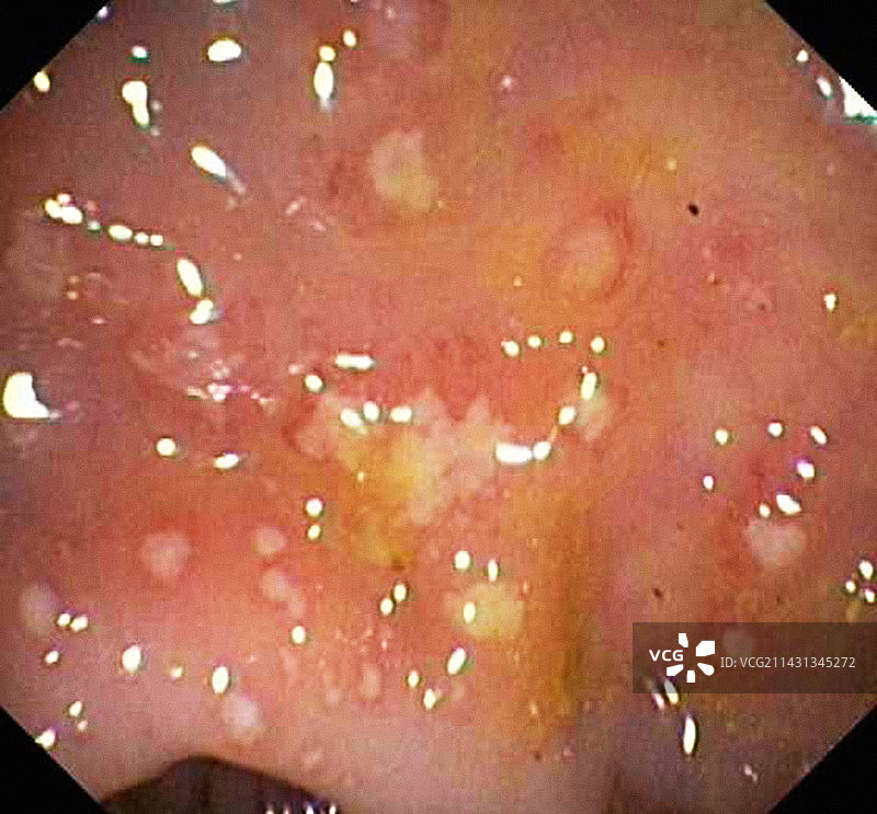 结肠炎，内窥镜观察图片素材