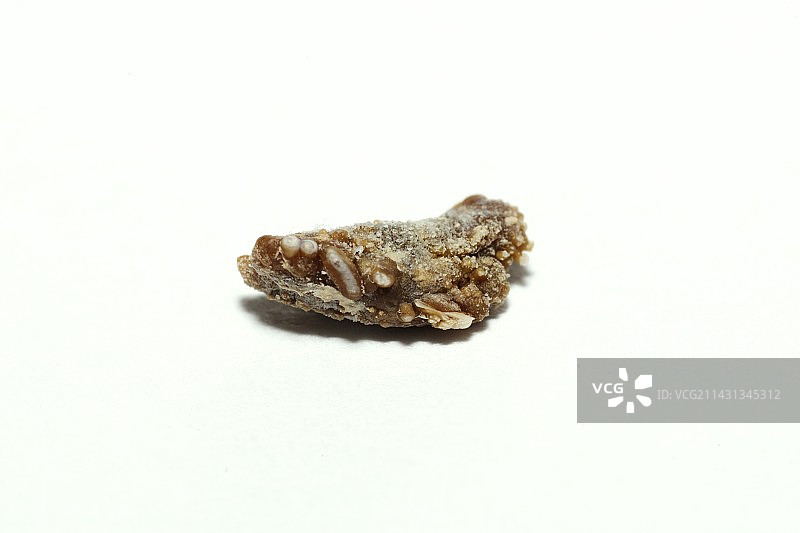 肾结石图片素材