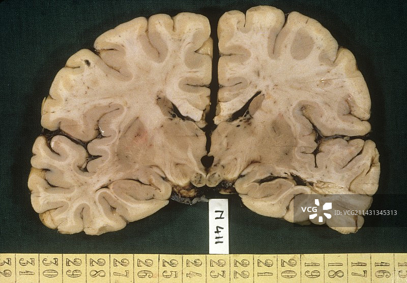 韦尼克脑病中的大脑图片素材