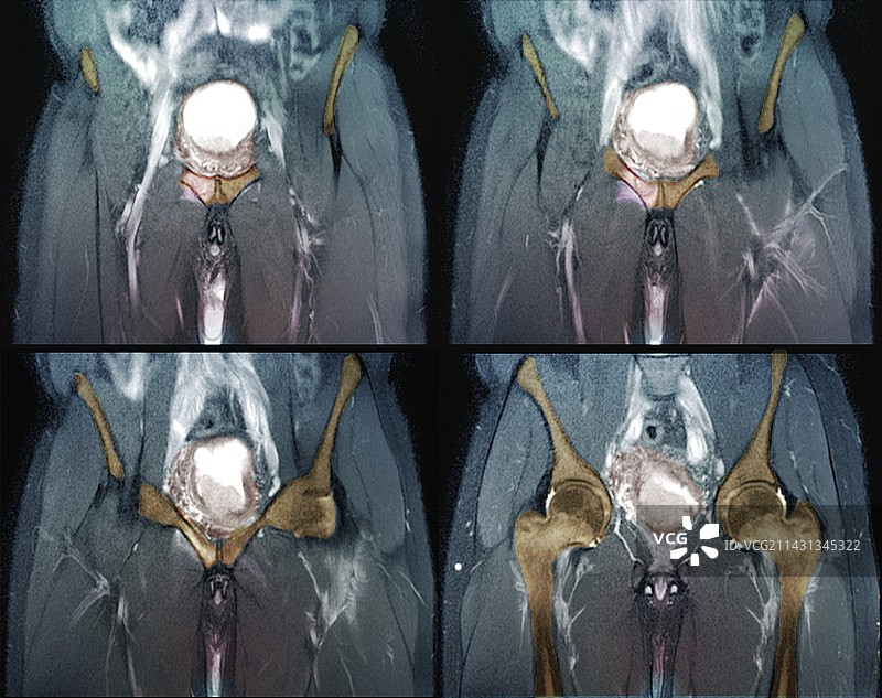 转移性膀胱癌的核磁共振成像图片素材