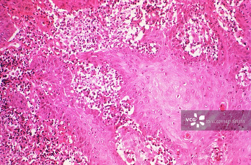 腹股沟肉芽肿显微照片图片素材