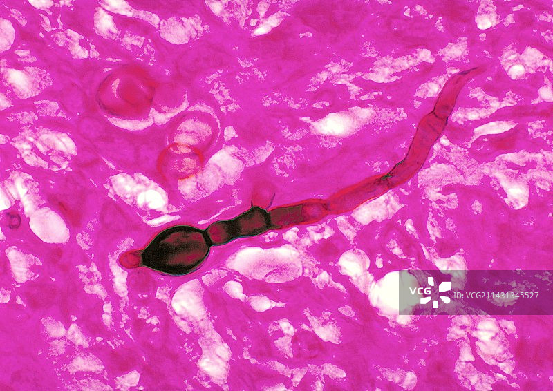 芽生菌病显微照片图片素材