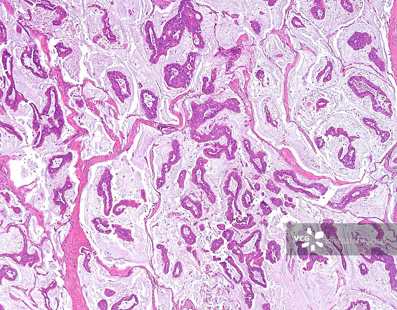 结肠黏液腺癌显微照片图片素材