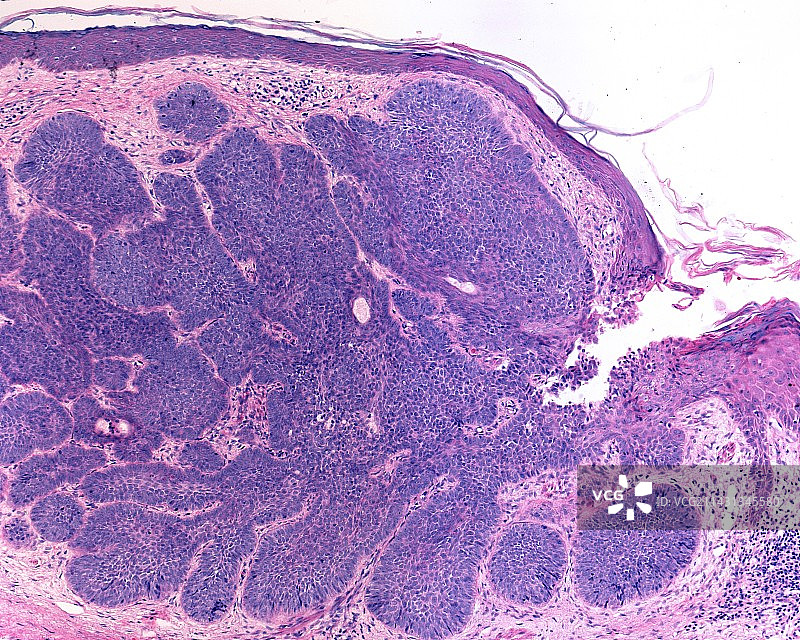 基底细胞癌浅显显微照片图片素材