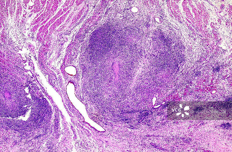 心脏壁的树胶肿，光学显微照片图片素材