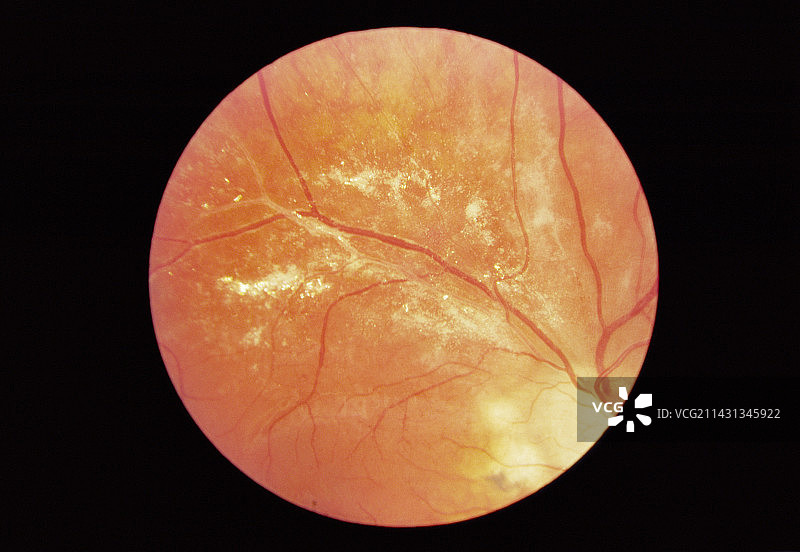 艾滋病毒性视网膜炎图片素材