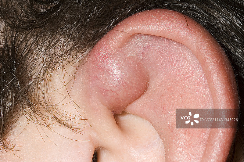 感染性皮样囊肿图片素材