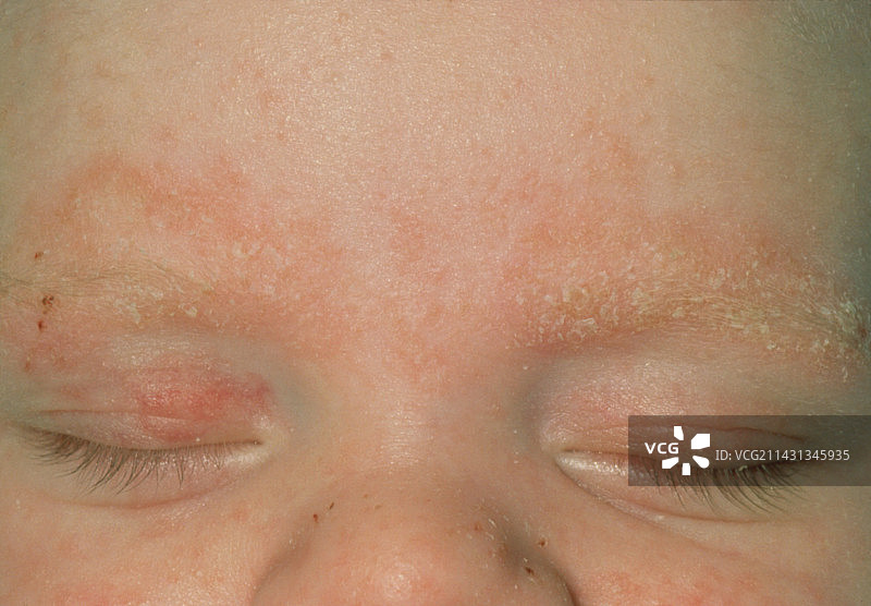 婴儿脂溢性皮炎面部特写图片素材