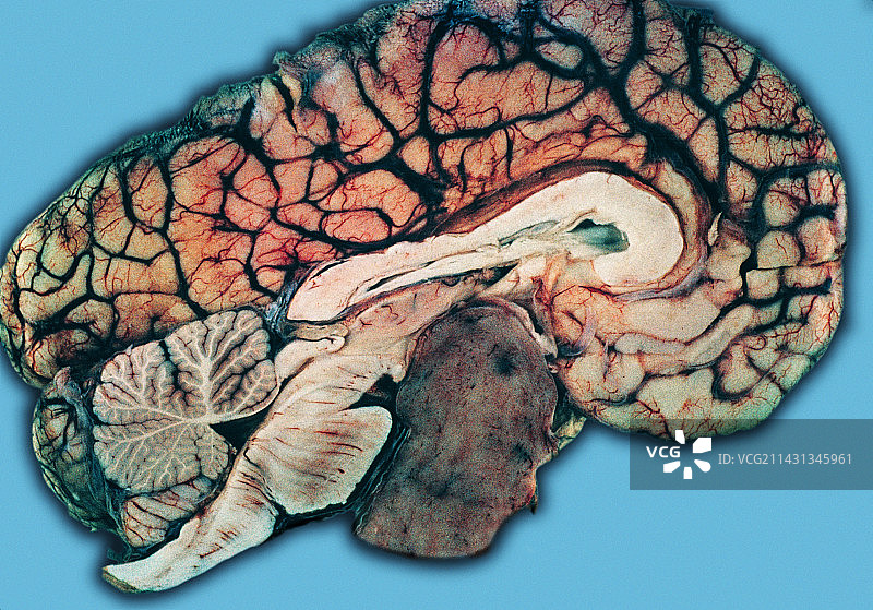 垂体瘤图片素材
