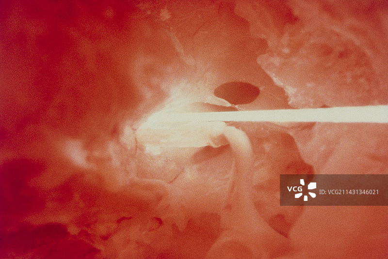 激光耳科手术的内窥镜视图图片素材