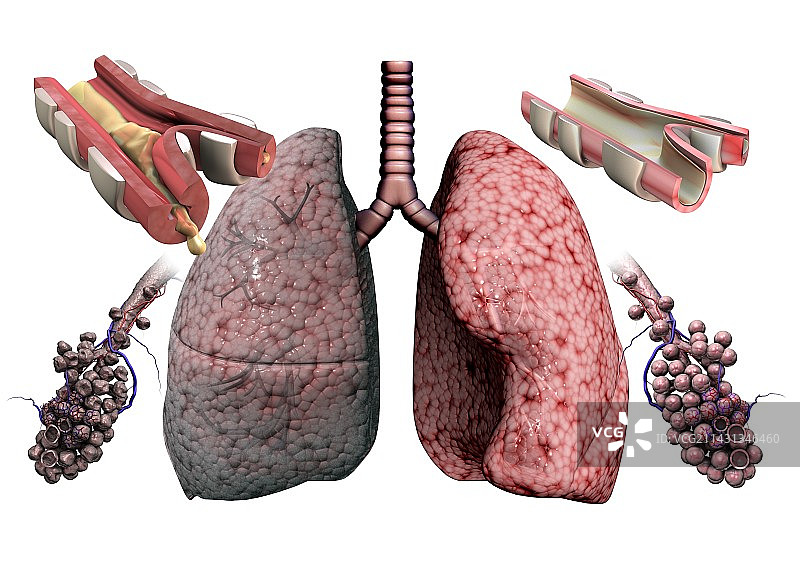慢性阻塞性肺病插图图片素材