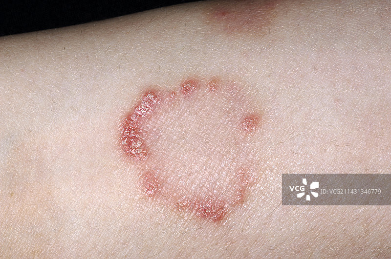 治疗8周后的牛皮癣图片素材