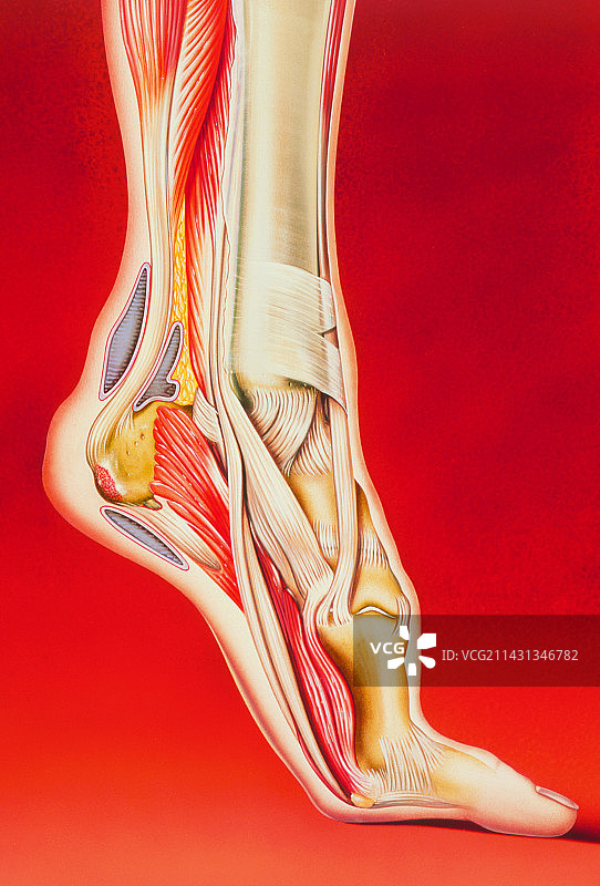 跟骨骨刺与足部疼痛示意图图片素材
