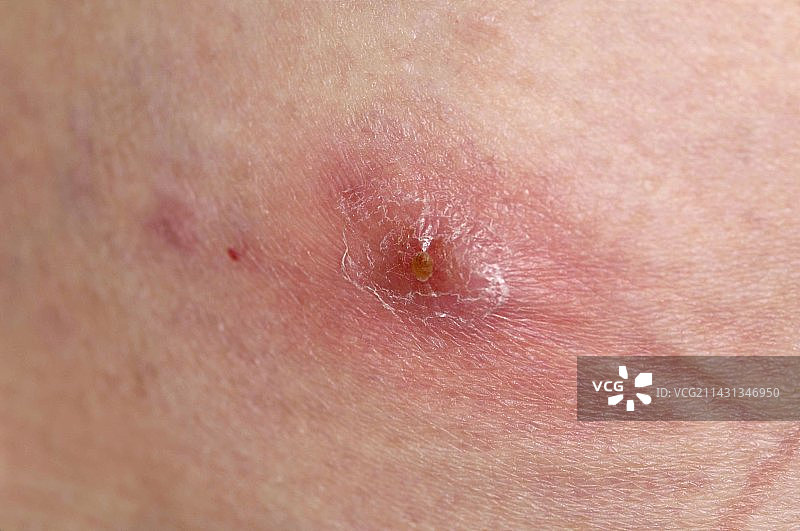 腹部脓肿图片素材