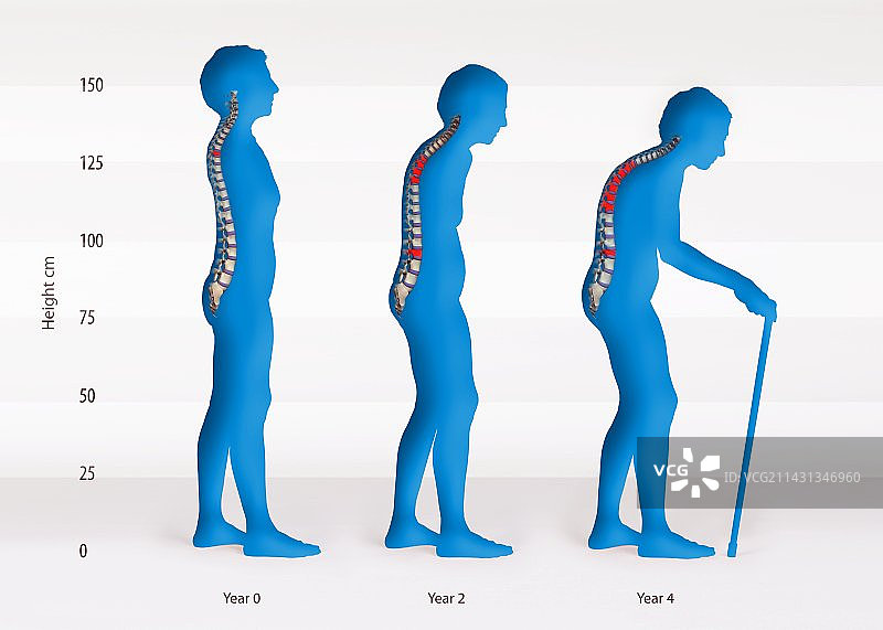 骨质疏松症的进展图片素材