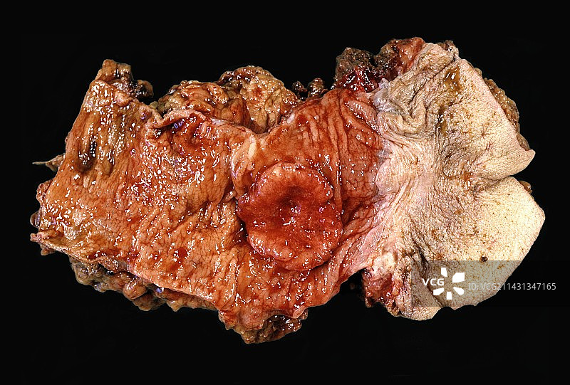 直肠癌图片素材