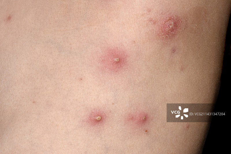 胸部毛囊炎图片素材