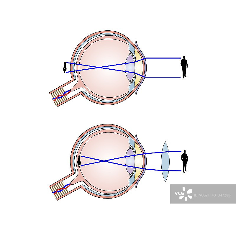 远视矫正示意图图片素材
