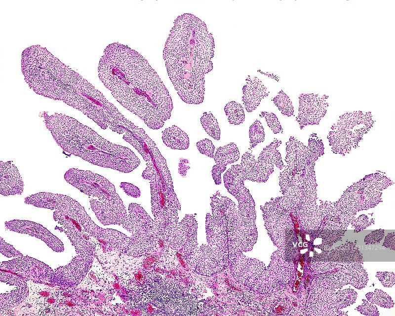 膀胱乳头状癌，光学显微照片图片素材